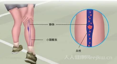 小腿酸胀警惕四种病日常预防措施