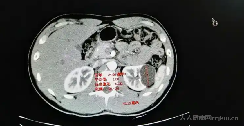 肾囊肿会自己消失吗