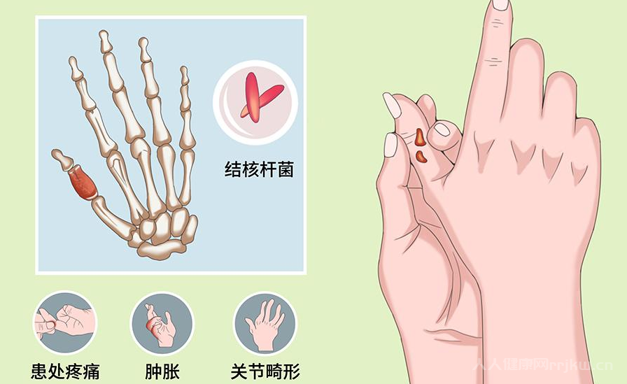 骨关节结核最常见的发生部位