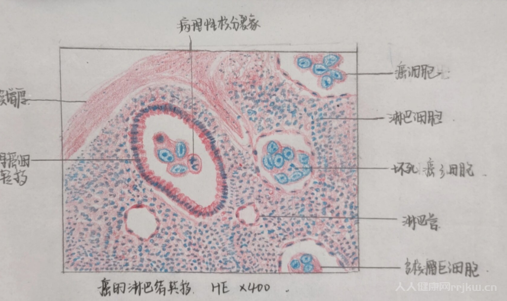 癌症为什么会转移淋巴癌