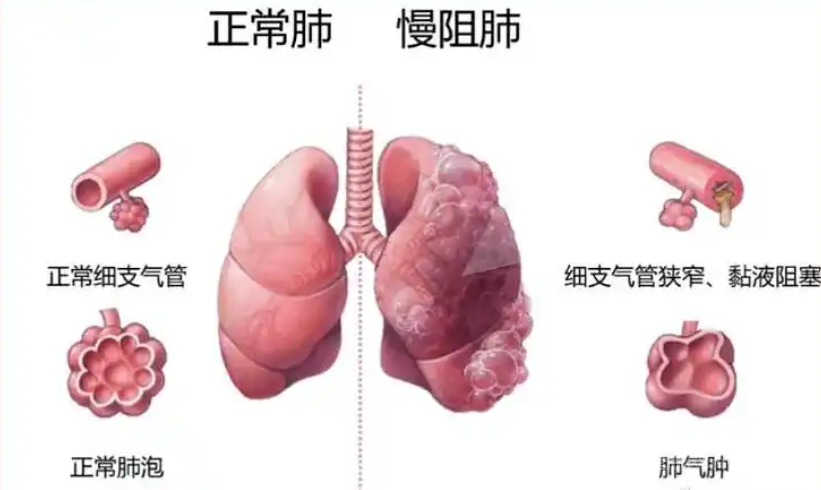 肺心病早期症状是什么