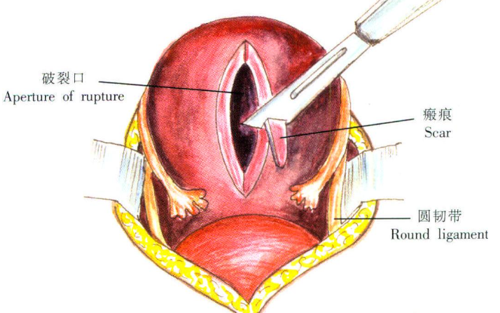 如何预防子宫破裂？