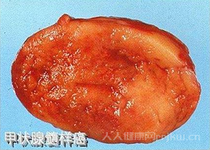 甲状腺髓样癌能活多久