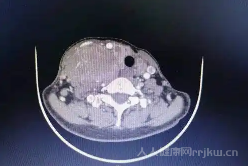 甲状腺髓样癌可以通过基因检测来诊断吗？