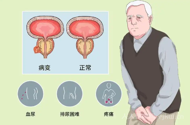 哪些生活方式可能影响前列腺癌三项化验指标？