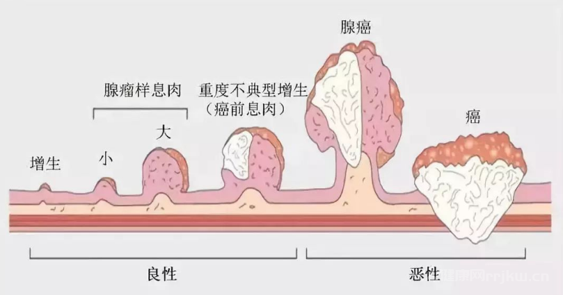 息肉和痔疮区别图