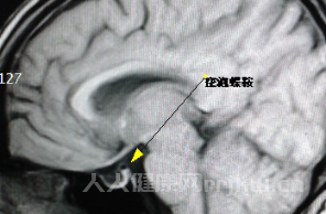 空泡蝶鞍什么意思