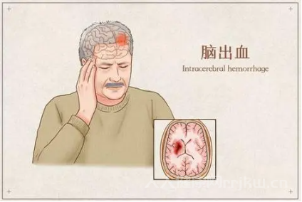 脑出血前的8个征兆一定要注意
