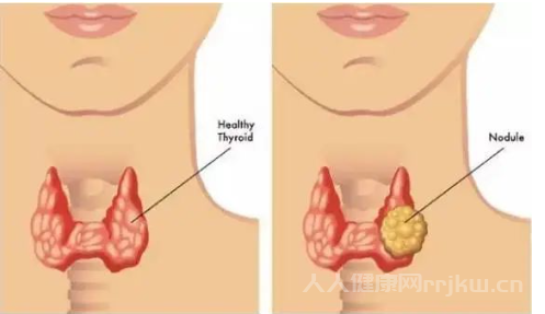 甲状腺瘤是什么病