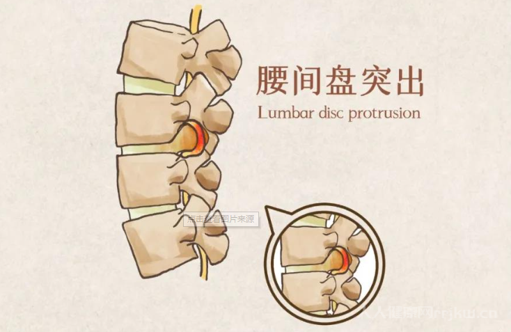 腰间盘突出的锻炼方法