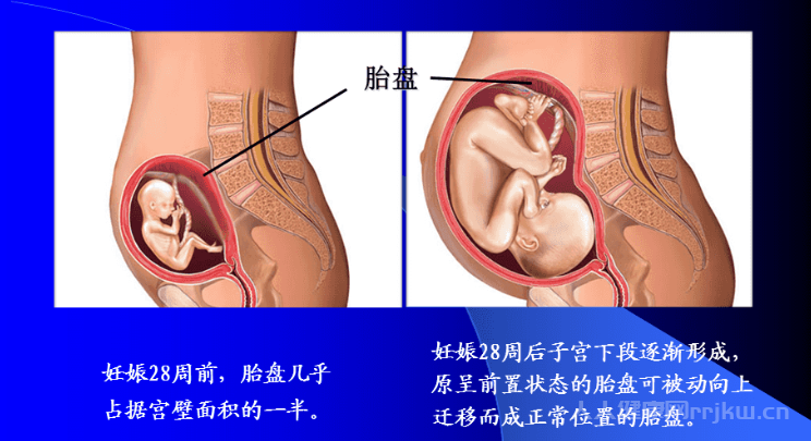 前置胎盘是什么意思