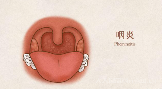 慢性咽炎怎么除根求民间偏方