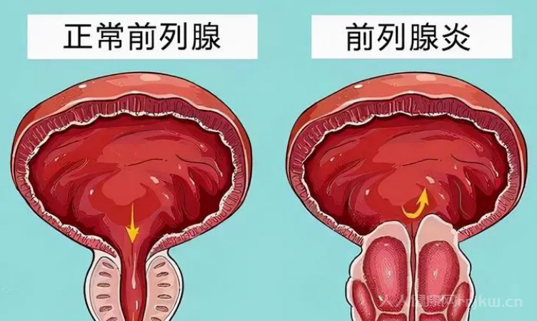 前列腺炎危害9种常见危害解析