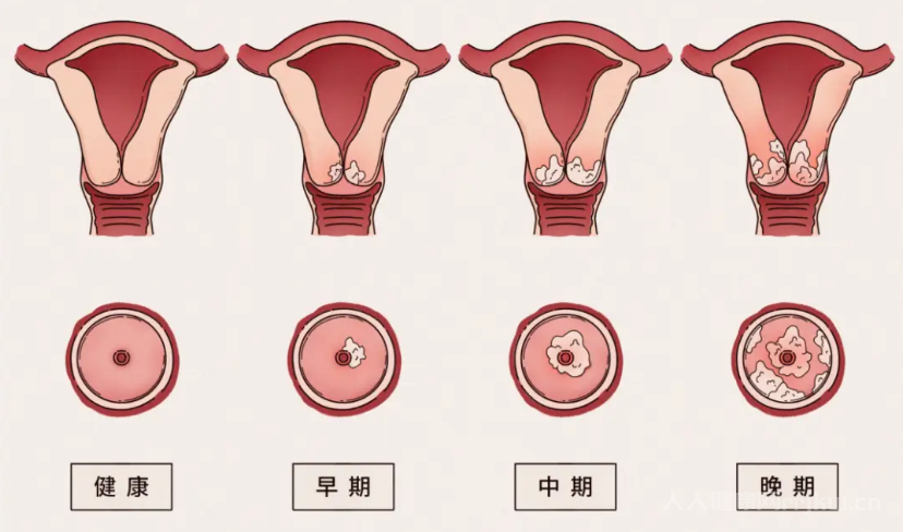 宫颈病变的五个阶段是什么