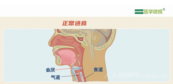 食物进入气管后最终去哪儿了