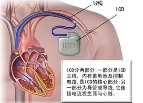 icd医学上是什么意思